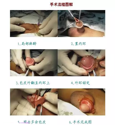 包皮手术最新方法探讨