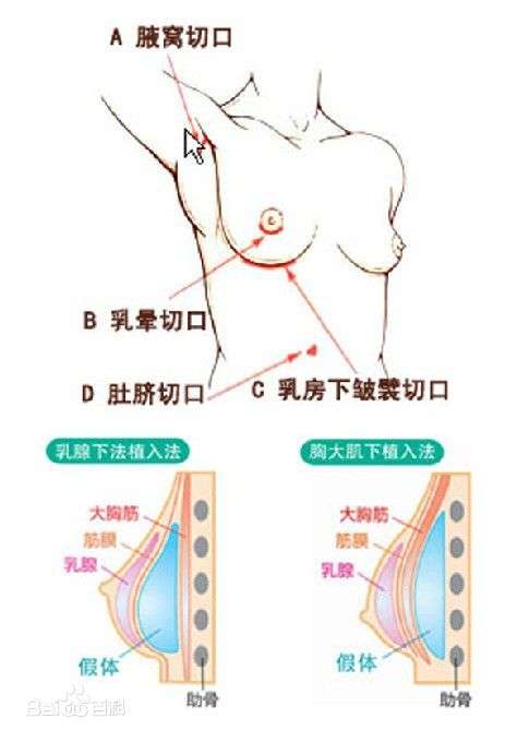 探索最新隆胸方法，科技与自然美的融合之旅